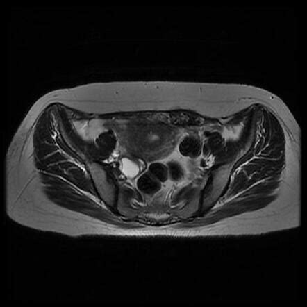 endometriosis abdominal wall radiology
